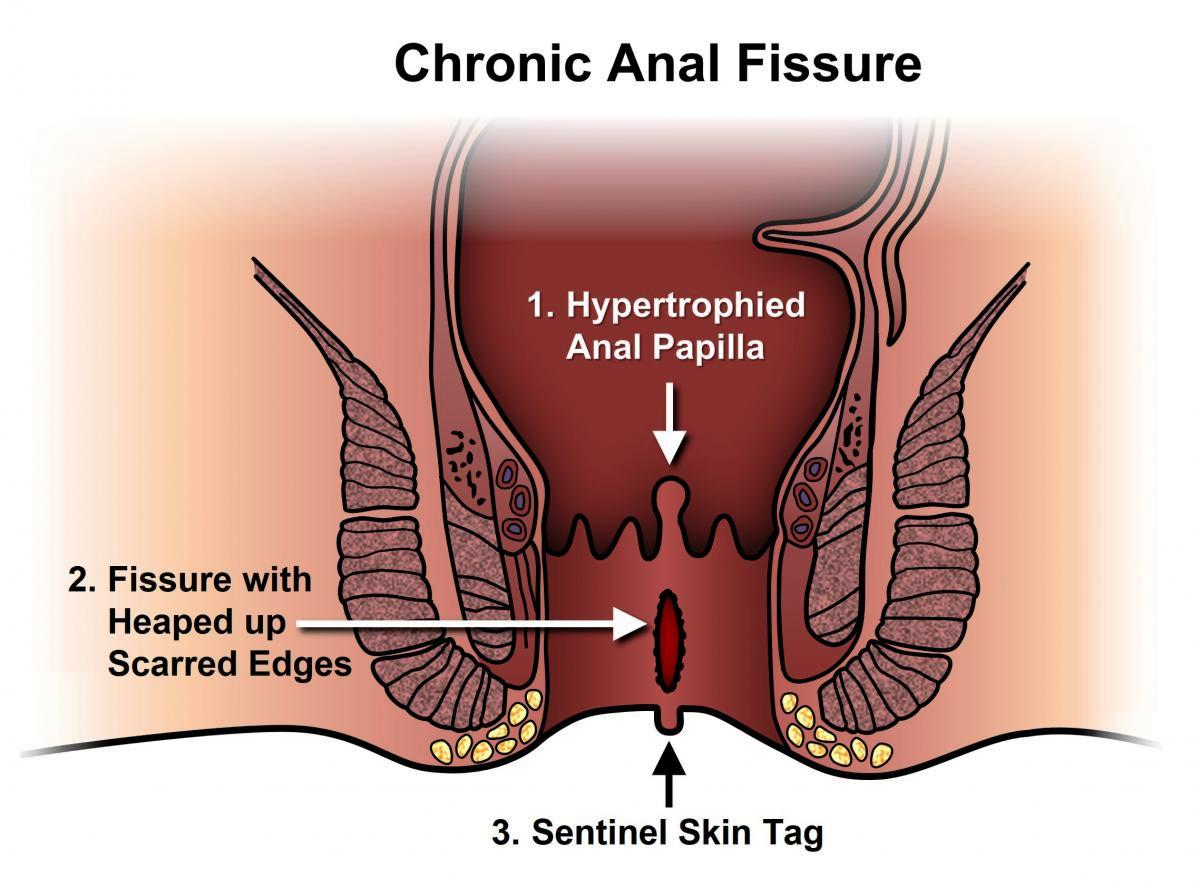 Laser Treatment for Anal Fistula